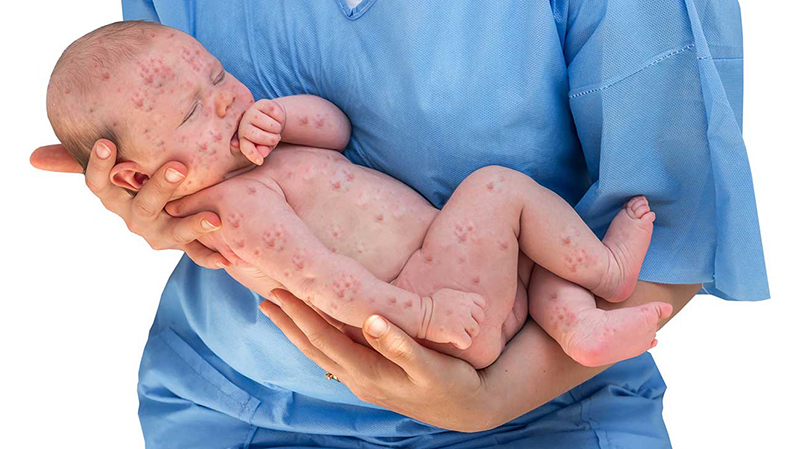Nếu mẹ và bé bất đồng nhóm máu cũng có thể gây ra hiện tượng vàng da ở trẻ sơ sinh