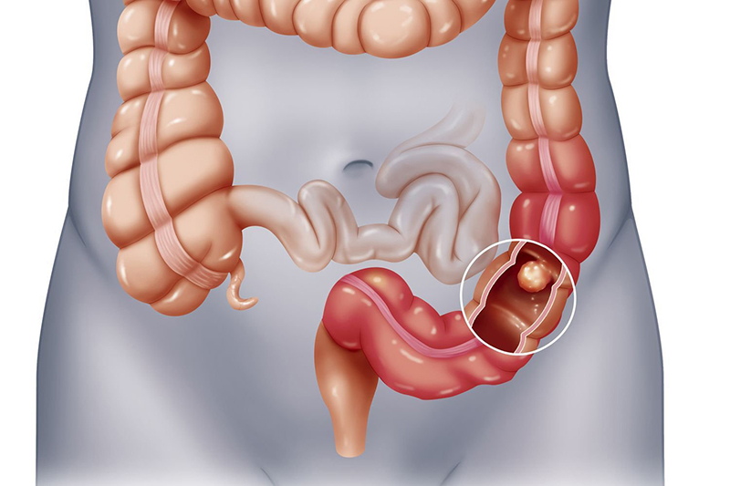 Phần lớn bệnh nhân đau ruột thừa có nguyên nhân bắt nguồn từ sự viêm nhiễm