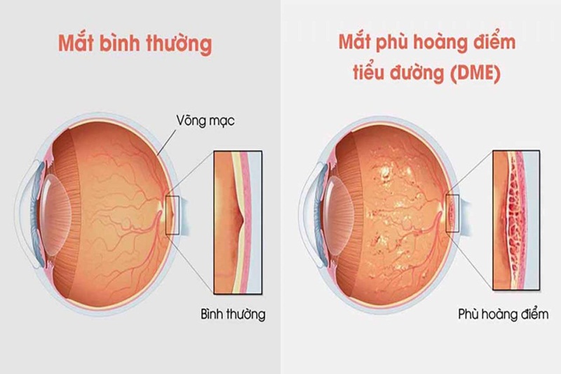 Phù hoàng điểm có thể do biến chứng của bệnh đái tháo đường gây ra