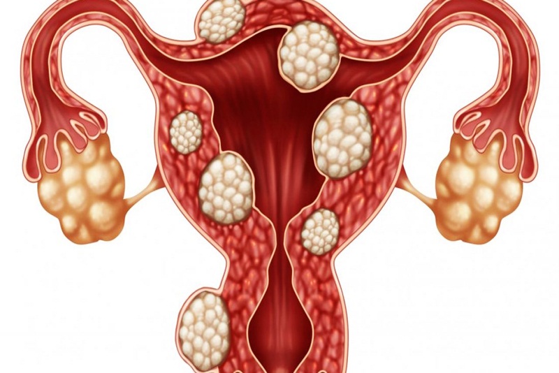 U xơ tử cung là những khối u lành tính 