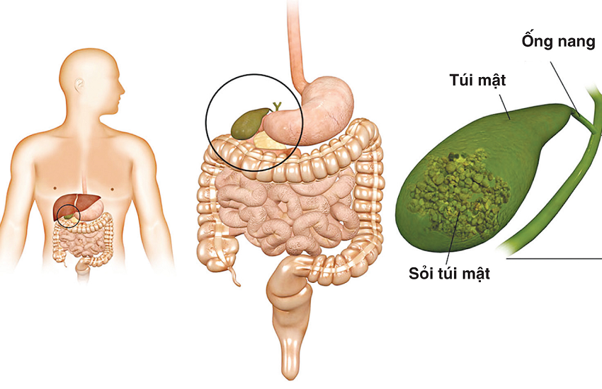 Triệu chứng chính của sỏi mật