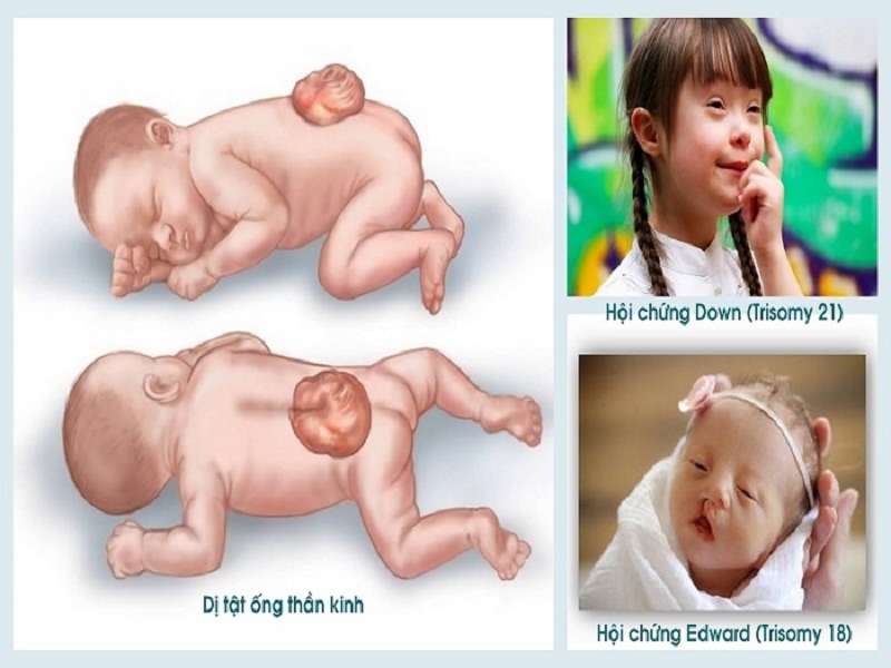 Các loại dị tật có thể tìm thấy trong xét nghiệm Double test và Triple test