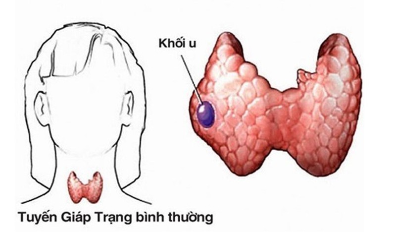 Bệnh u tuyến giáp lành tính