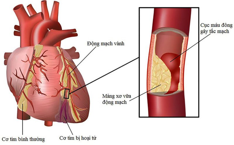 Cẩn thận khó thở tim đập nhanh do bệnh động mạch vành