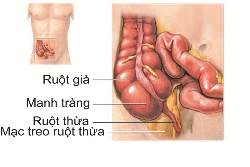 viêm ruột thừa có cần mổ hay không 