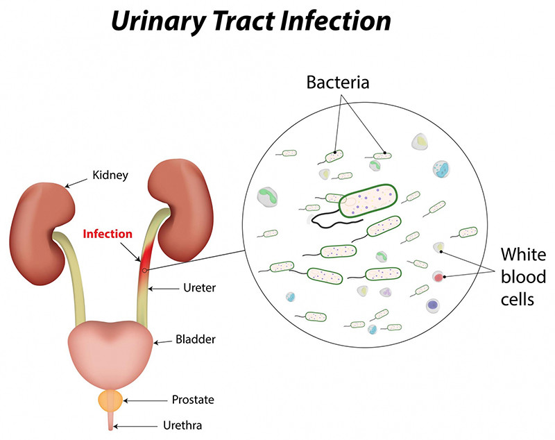 Nước tiểu sẫm màu một trong những dấu hiệu nhận biết viêm đường tiết niệu