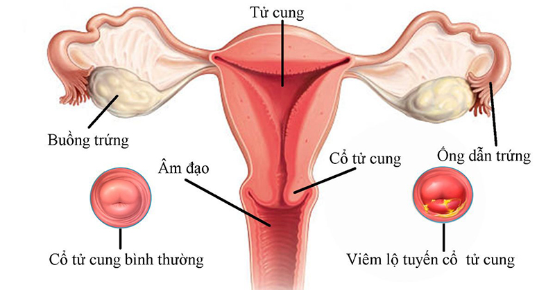 Viêm lộ tuyến cổ tử cung là căn bệnh gây ra bởi sự tấn công của các tế bào tuyến