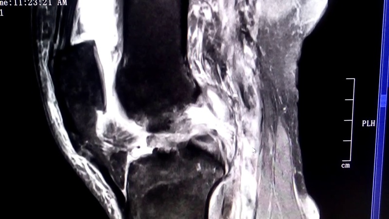Chụp MRI giúp chẩn đoán chính xác đứt dây chằng chéo sau