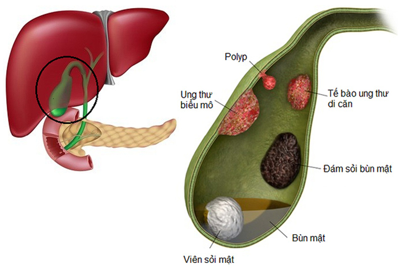 Polyp túi mật kích thước lớn là nguyên nhân cần cắt bỏ túi mật 