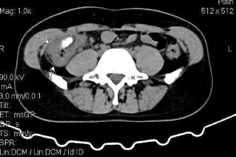 Hình ảnh viêm manh tràng được ghi lại khi chụp CT ổ bụng