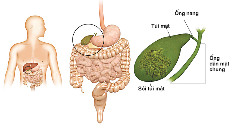 Sỏi túi mật là bệnh lý phổ biến hiện nay 