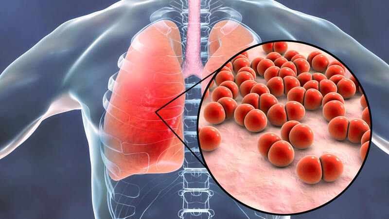 Bệnh phổi kẽ là bệnh khó điều trị và gây nhiều tổn thương khó hồi phục
