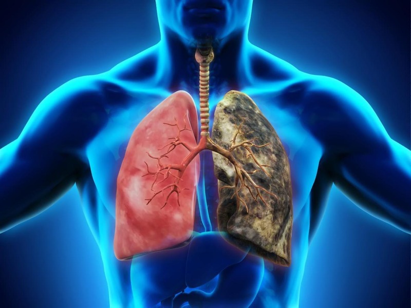 Bệnh phổi kẽ có thể nguy hiểm khi tiến triển bệnh nhanh gây biến chứng