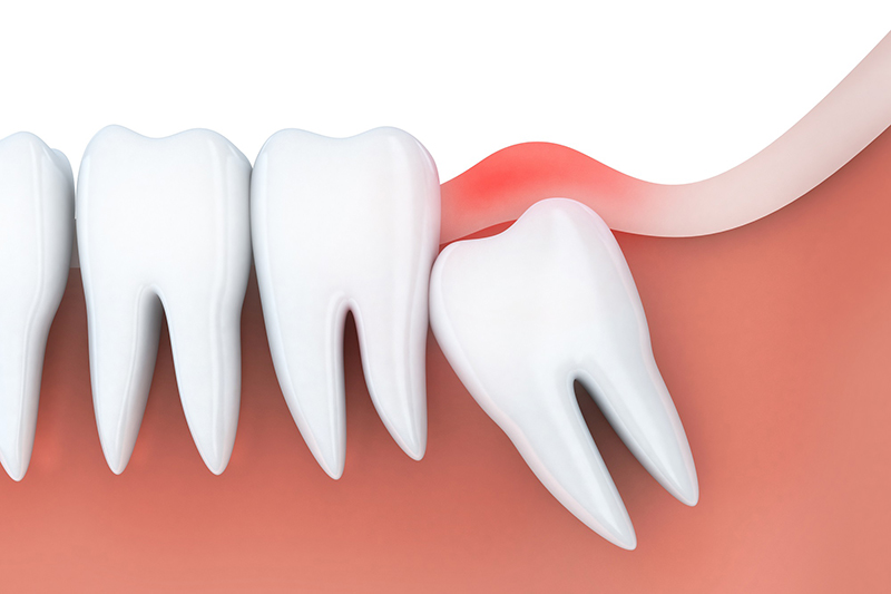 Giúp bạn trả lời: Nhổ răng khôn bao lâu thì lành? – Medlatec.vn