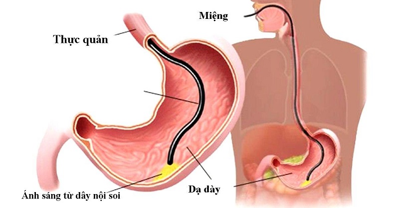 Nội soi là phương pháp hỗ trợ chẩn đoán các bệnh lý đường tiêu hóa