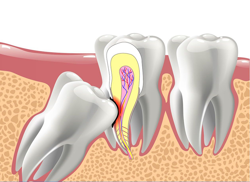 Tình trạng của răng khôn sẽ ảnh hưởng đến việc nhổ răng khôn bao lâu thì lành