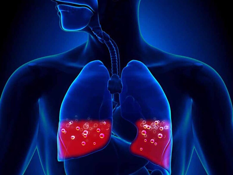 Phù phổi cấp là biến chứng cấp tính nguy hiểm