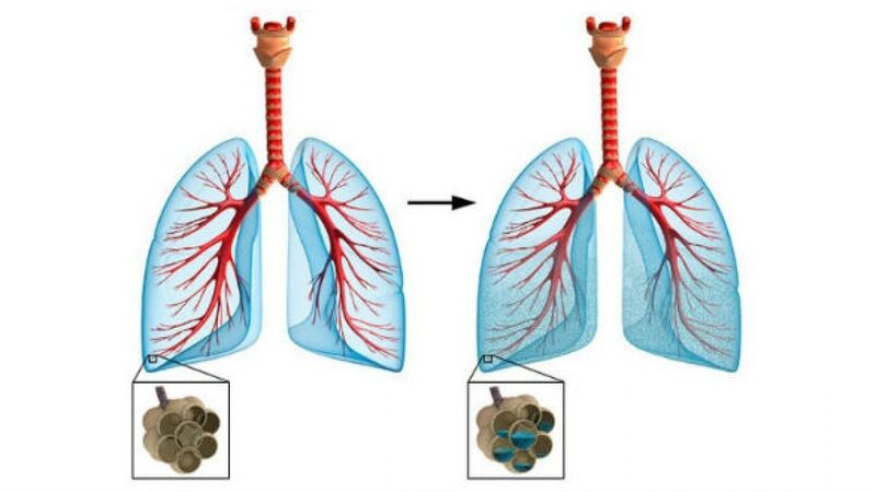 Phù phổi cấp giai đoạn phế nang là nguy hiểm nhất