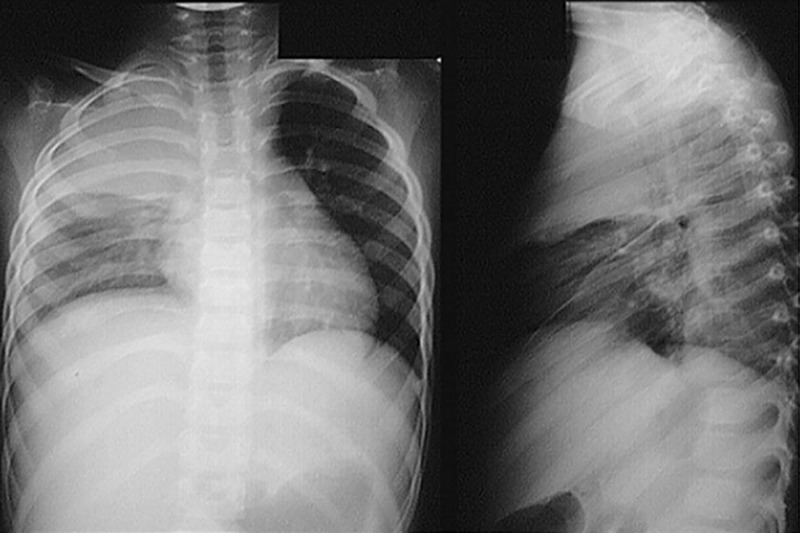 Chụp X-quang thường dùng trong chẩn đoán phù phổi cấp