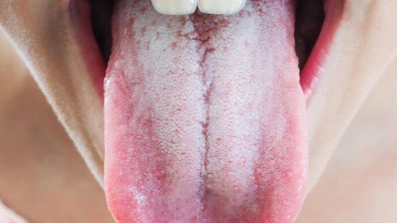 Lưỡi trắng là bệnh gì