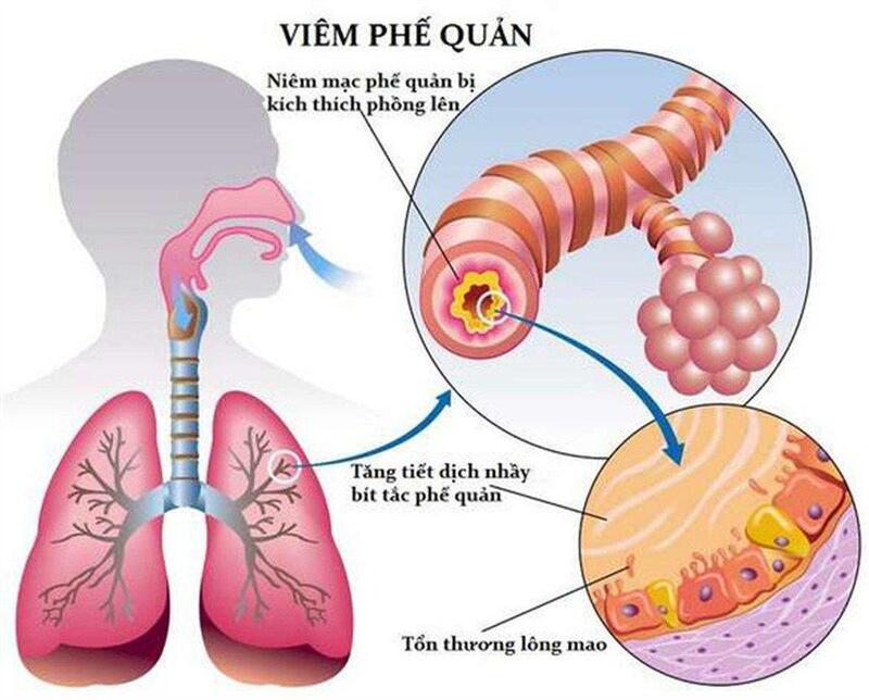 Viêm Phế Quản và Viêm Phổi: Triệu Chứng và Cách Điều Trị Hiệu Quả