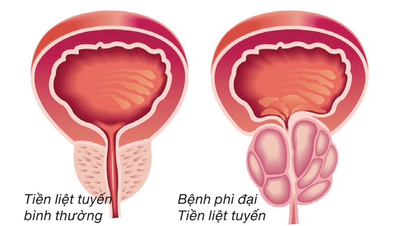 Phì đại tuyến tiền liệt thường xảy ra ở nam giới trên 50 tuổi