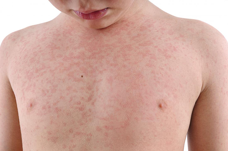 phát ban là triệu chứng điển hình của bệnh rubella