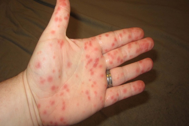 Sốt Virus Giảm Tiểu Cầu: Nguyên Nhân, Triệu Chứng và Cách Phòng Ngừa Hiệu Quả