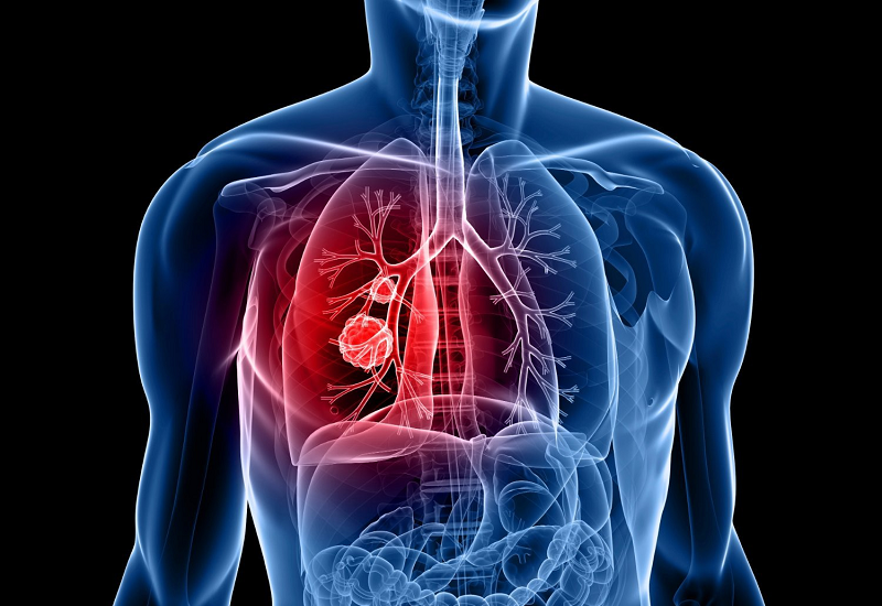 Ung thư tuyến tiền liệt giai đoạn cuối có thể di căn đến phổi