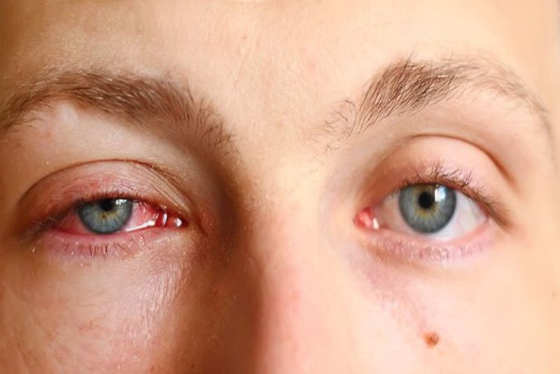 Mắt đỏ là dấu hiệu của bệnh gì 