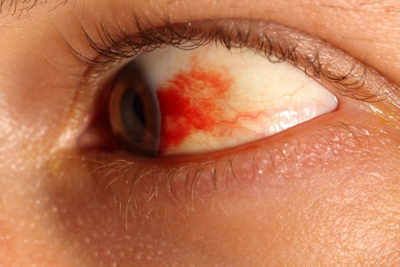 Mắt đỏ do bệnh xuất huyết dưới mắt
