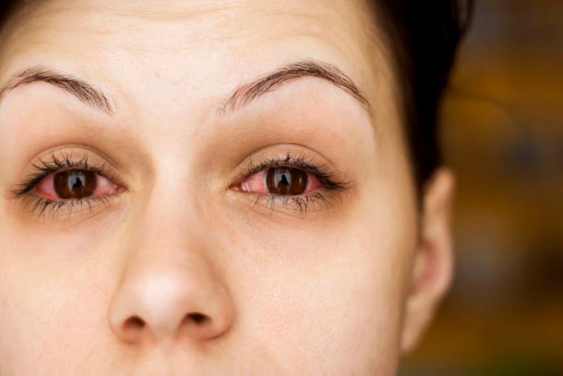 Nhiều người cho rằng nhìn vào mắt người bị đau mắt đỏ bị lây bệnh, nhưng đây là quan điểm sai lầm