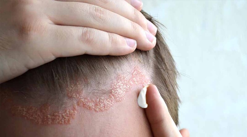 Các bệnh về da đầu ở nam giới - 5 bệnh lý phổ biến nhất | Medlatec