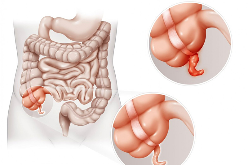 Đau ruột thừa có thể gây ra bởi một nguyên nhân nào đó hoặc khối u ruột