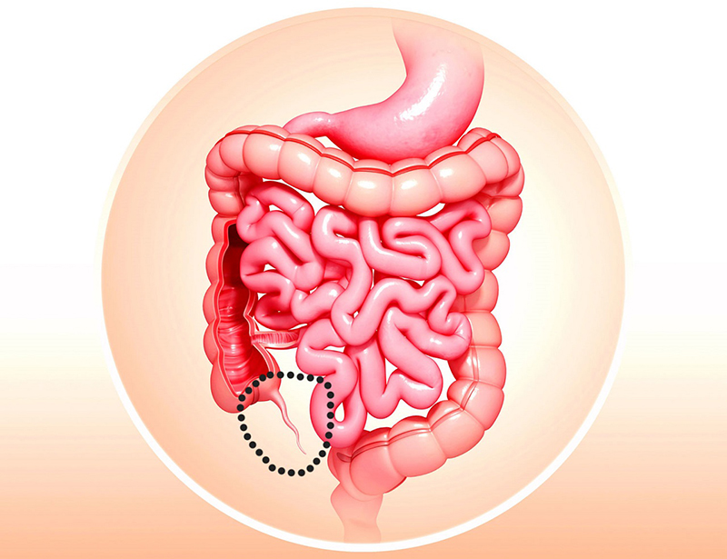 Chuyên gia giải đáp: Đau ruột thừa ở vị trí nào?