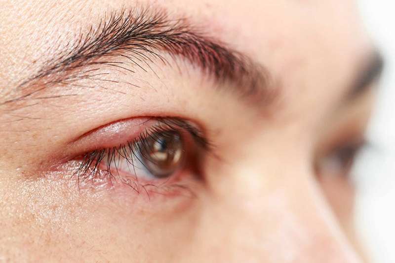 Những cách trị đỏ mắt hiệu quả an toàn thường được áp dụng hiện nay