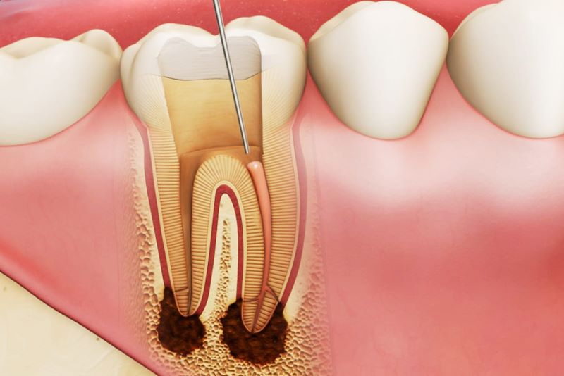 Chữa tủy răng có đau không 