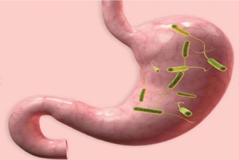 Helicobacter pylori là một trong những nguyên nhân gây viêm loét dạ dày