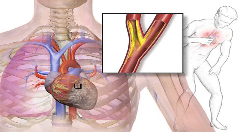 Người bị bệnh mạch vành thường có cơn đau thắt ngực dữ dội đột ngột