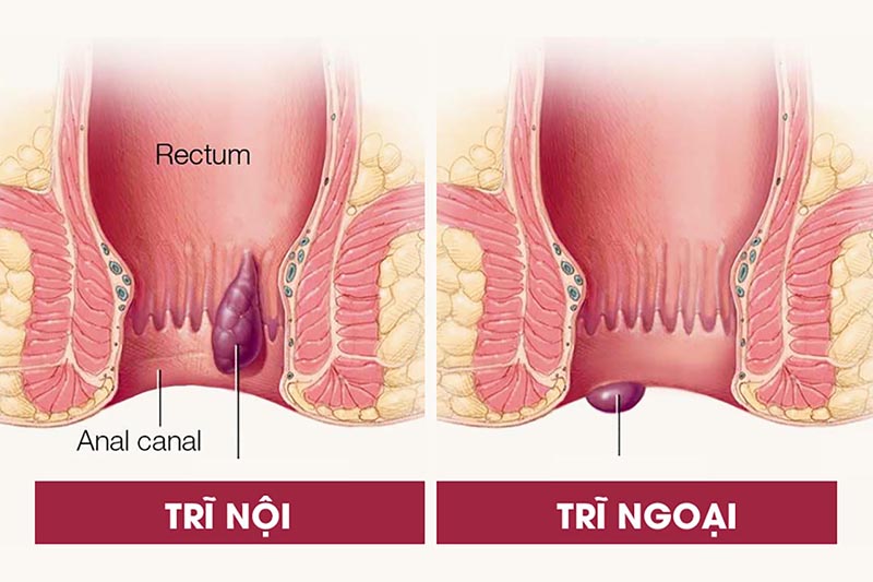 Trĩ được chia làm hai loại chính là trĩ nội và trĩ ngoại