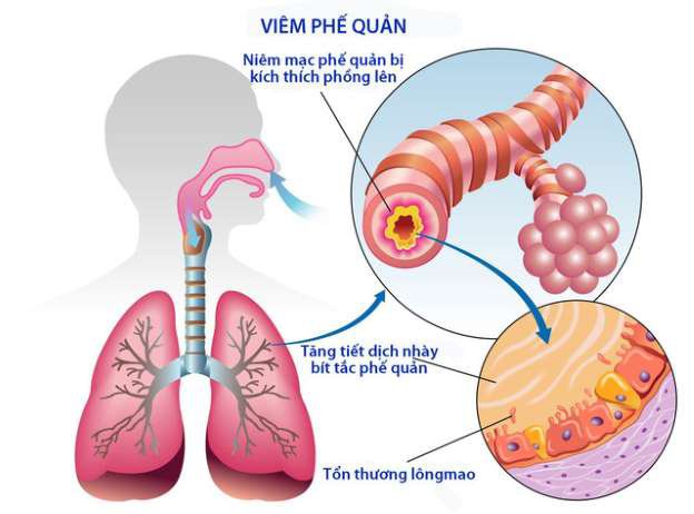 Viêm Phế Quản Nặng: Nguyên Nhân, Triệu Chứng và Cách Điều Trị Hiệu Quả