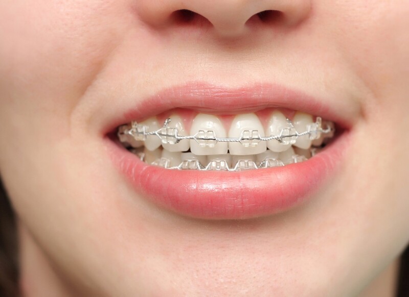 Nhiều người lựa chọn niềng răng để khắc phục răng mọc lệch