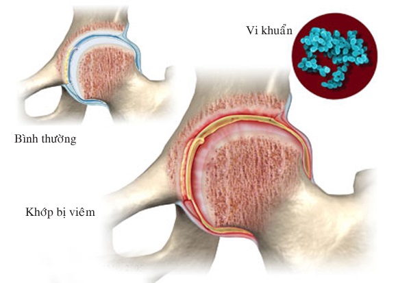 Viêm khớp nhiễm khuẩn