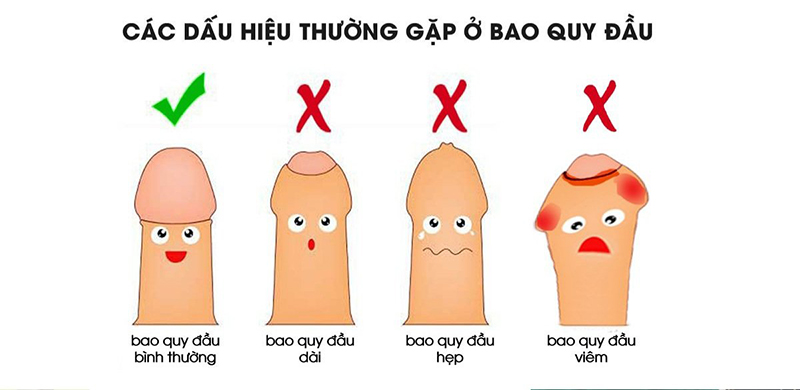 Một số tình trạng bất thường dương vật mà nam giới thường gặp