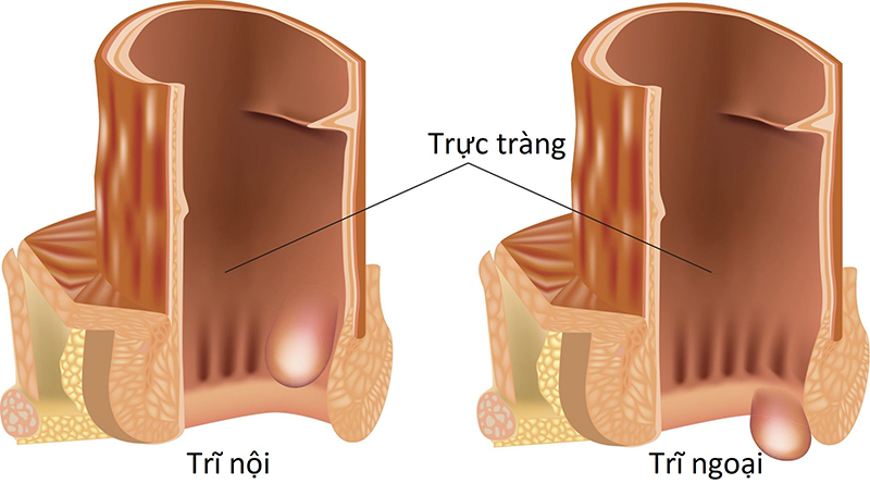 Trĩ nội (hình trái) và trĩ ngoại (hình phải) là hai loại trĩ phổ biến và có những triệu chứng khá giống nhau
