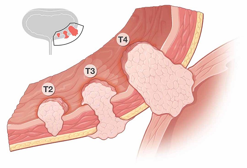 Dựa trên mức độ xâm lấn của khối u mà ung thư bàng quang được chia thành 4 giai đoạn