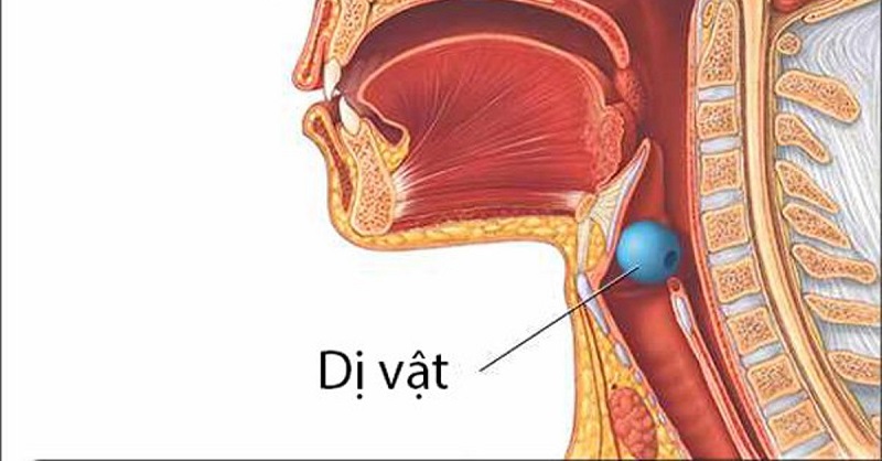 Dị vật mắc trong đường hô hấp