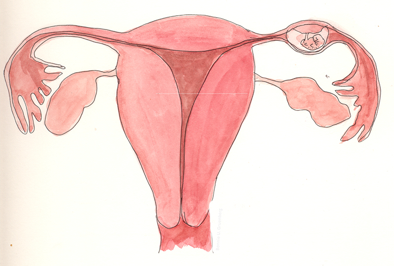 Thai ngoài tử cung là hiện tượng vô cùng nguy hiểm với các sản phụ