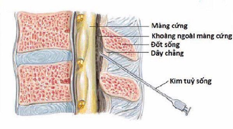 Tiêm giảm đau ngoài màng cứng điều trị thoát vị đĩa đệm cột sống thắt lưng