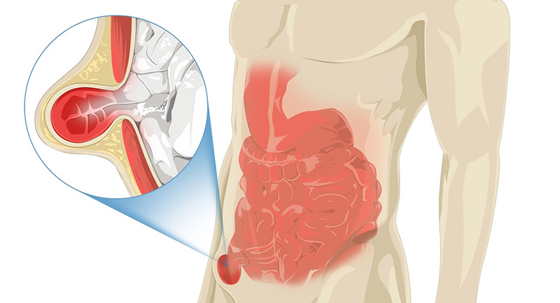 Thoát vị nghẹt nếu không chữa trị có thể gây hoại tử ruột